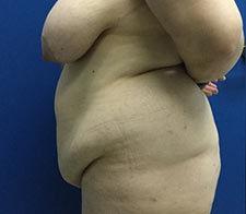 Abdominoplasty