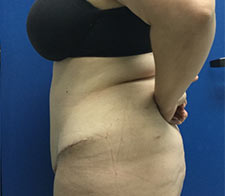 Abdominoplasty (Tummy Tuck)