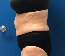 Abdominoplasty (Tummy Tuck)