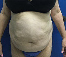 Abdominoplasty