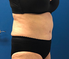 Abdominoplasty (Tummy Tuck)