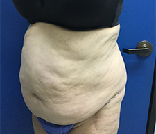 Abdominoplasty (Tummy Tuck)