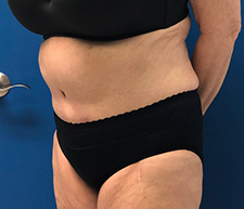 Abdominoplasty (Tummy Tuck)