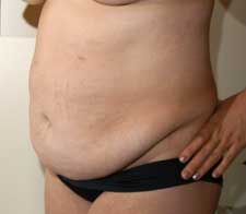 Abdominoplasty