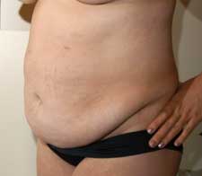 Abdominoplasty (Tummy Tuck)