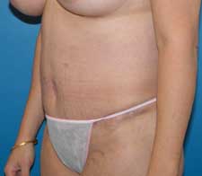 Abdominoplasty