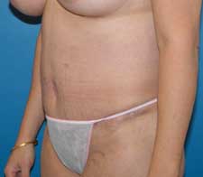 Abdominoplasty (Tummy Tuck)