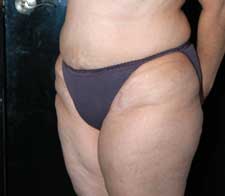 Abdominoplasty (Tummy Tuck)