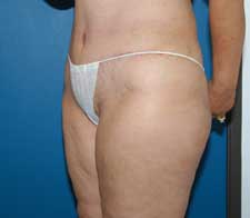 Abdominoplasty (Tummy Tuck)