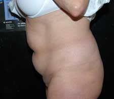 Abdominoplasty (Tummy Tuck)