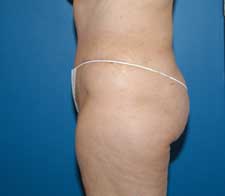 Liposuction