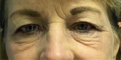 Eyelid Surgery