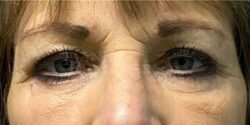 Eyelid Surgery