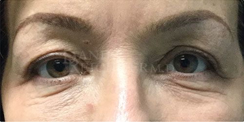Eyelid Surgery Case 292 Before Photo Eyelid Surgery