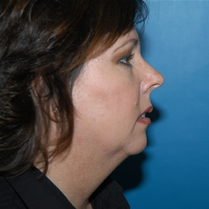 Facelift / Necklift