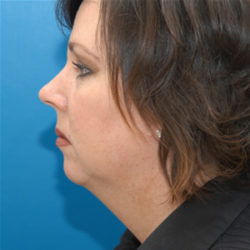 Facelift / Necklift