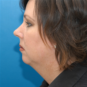 Facelift / Necklift