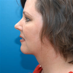 Facelift / Necklift