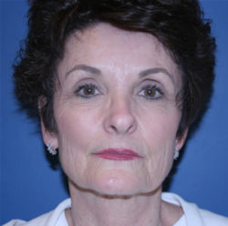 Facelift / Necklift