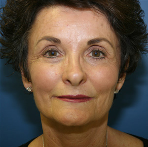 Plastic Surgery Facelift Results Orange County