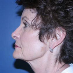 Facelift / Necklift