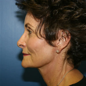 Facelift / Necklift