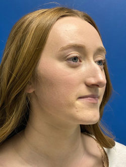 Rhinoplasty