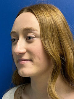 Rhinoplasty