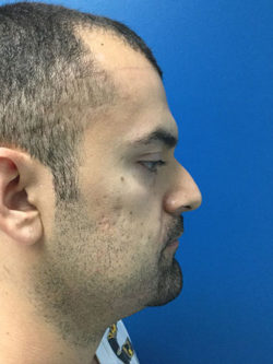 Rhinoplasty