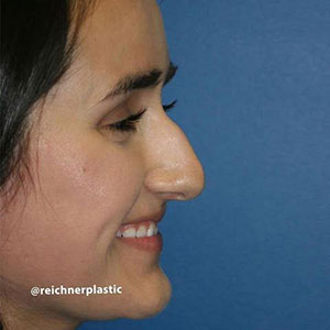 Rhinoplasty