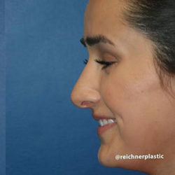 Rhinoplasty