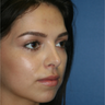 Rhinoplasty