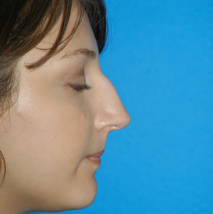 Rhinoplasty