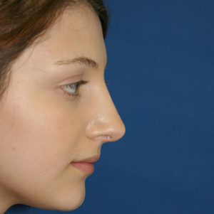 Rhinoplasty