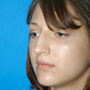 Rhinoplasty