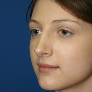 Rhinoplasty