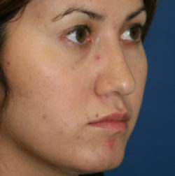 Rhinoplasty