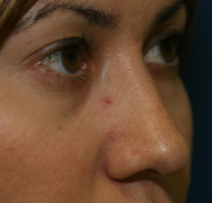 Rhinoplasty
