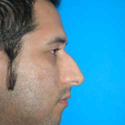 Rhinoplasty