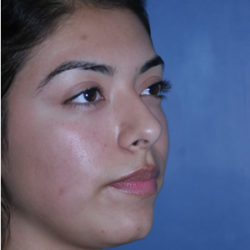 Rhinoplasty