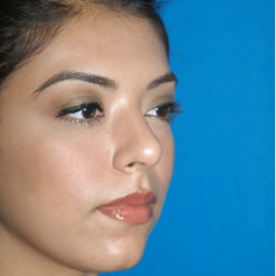 Rhinoplasty