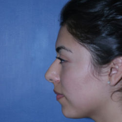 Rhinoplasty