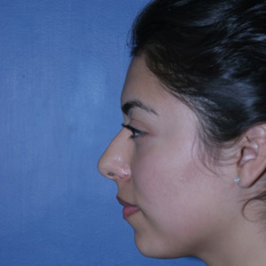 Rhinoplasty