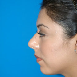 Rhinoplasty