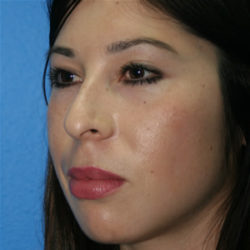 Rhinoplasty