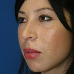 Rhinoplasty