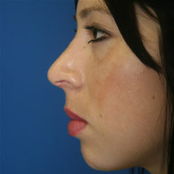 Rhinoplasty