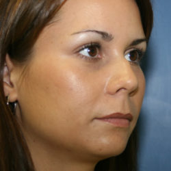 Rhinoplasty