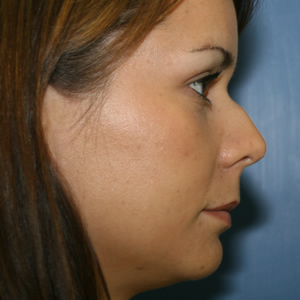 Rhinoplasty