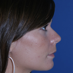 Rhinoplasty